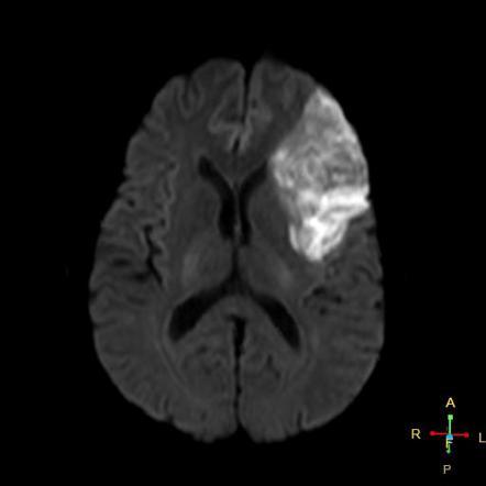 mri of stroke